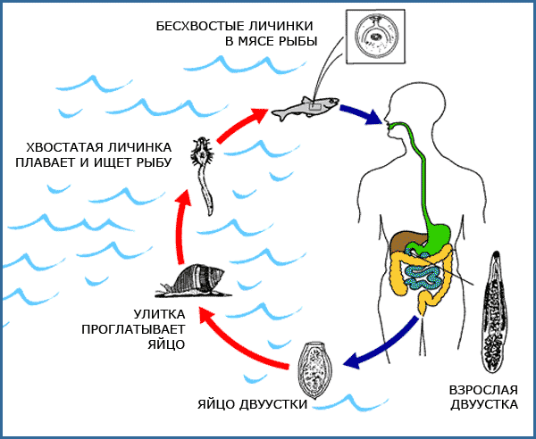 Описторхоз