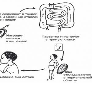 Энтеробиоз