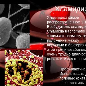 Хламидиоз